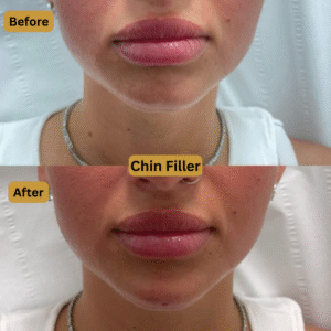 Chin Filler