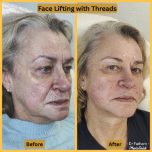 Face Lifting with Threads
