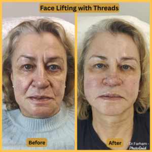 Face lifting with Threads (2)