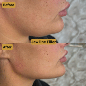 Jaw Line Filler (2)