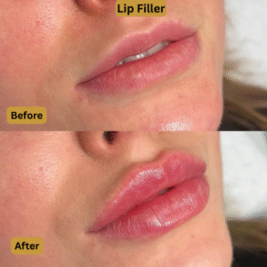 Lip Filler (2)