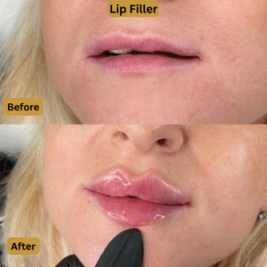 Lip Filler