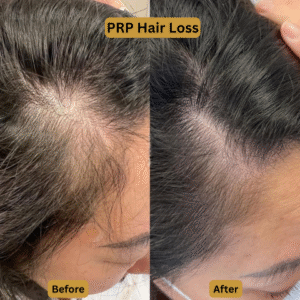 PRP Hair Loss (2)