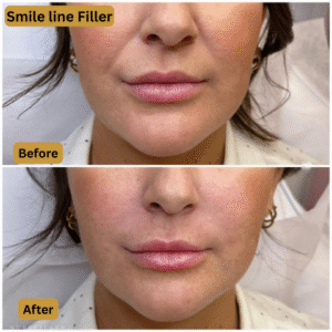 Smile line FIller
