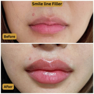 Smile line Filler (2)
