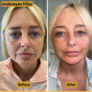 Undereyes Filler (2)