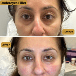 Undereyes Filler